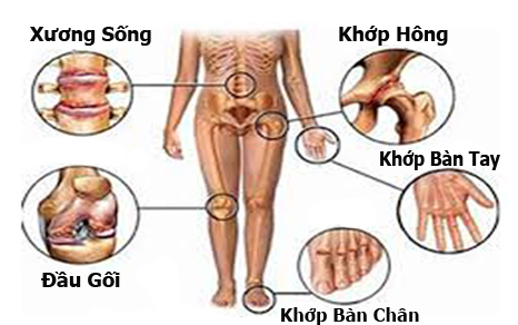 Thảo Dược Trị Xương Khớp