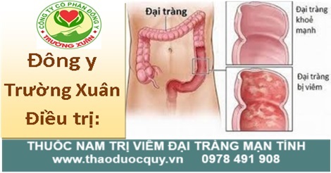 Thuốc nam Điều trị viêm đại tràng mạn tính