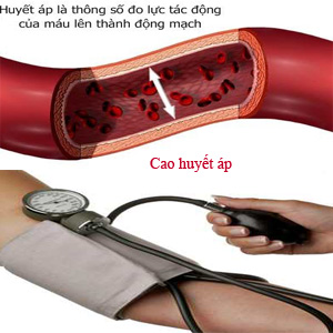 Bệnh Huyết Áp Cao-Những Điều Bạn Cần  Biết