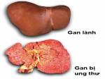 6 thảo dược giúp thải độc gan