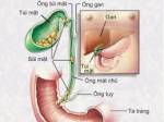 Bài thuốc trị Sỏi mật